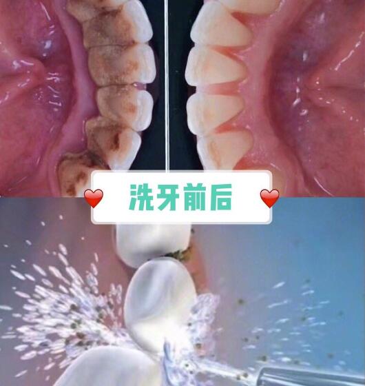 定期洗牙