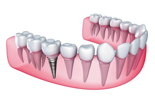 种植牙需要精心呵护